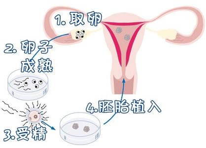 那里有正规供卵代孕